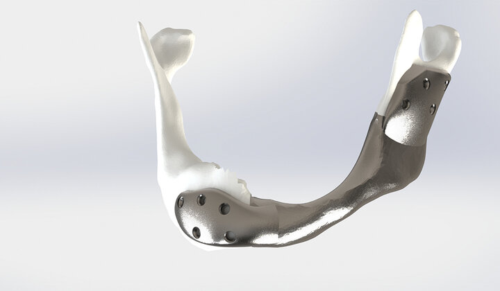 Eerste succesvolle operatie met 3D-geprinte titanium onderkaak