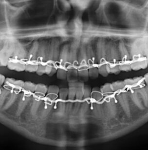 De etiologie van maxillofaciale fracturen